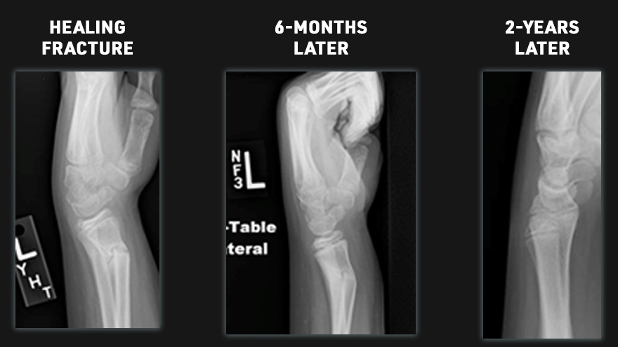 Healing fracture x-ray